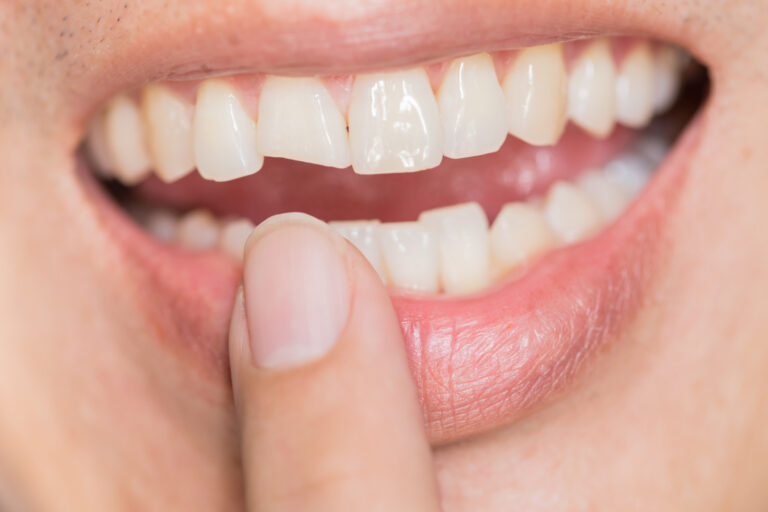 - A person points to a chipped lower front tooth, highlighting the dental issue. The upper row of teeth appears intact, emphasizing the contrast with the damaged area.