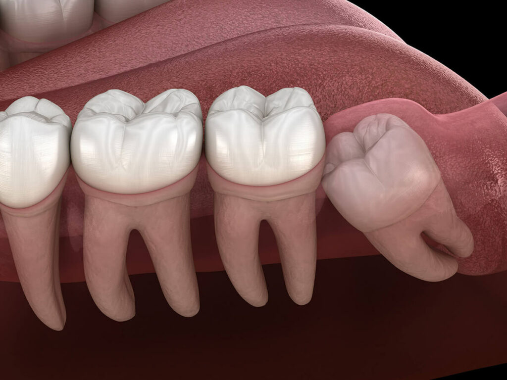 A mockup of an impacted wisdom tooth