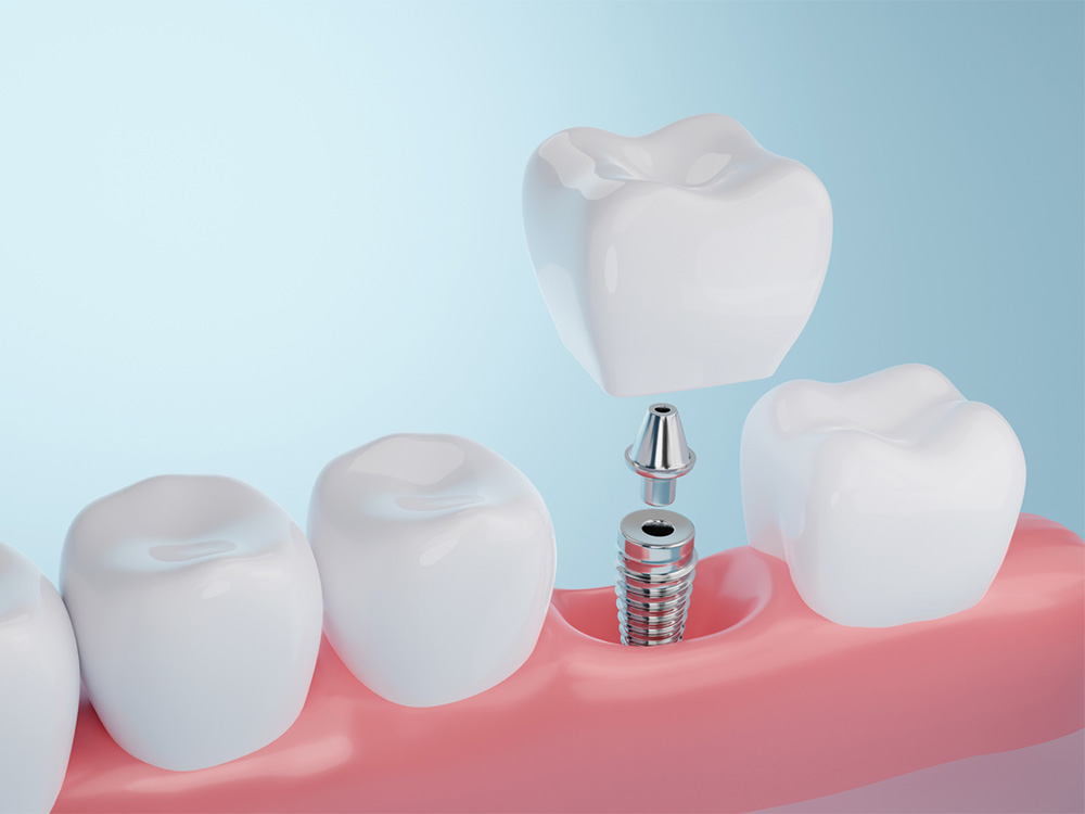 Dental Implant Being Fitted into Jaw Showing Post, Abutment and Crown