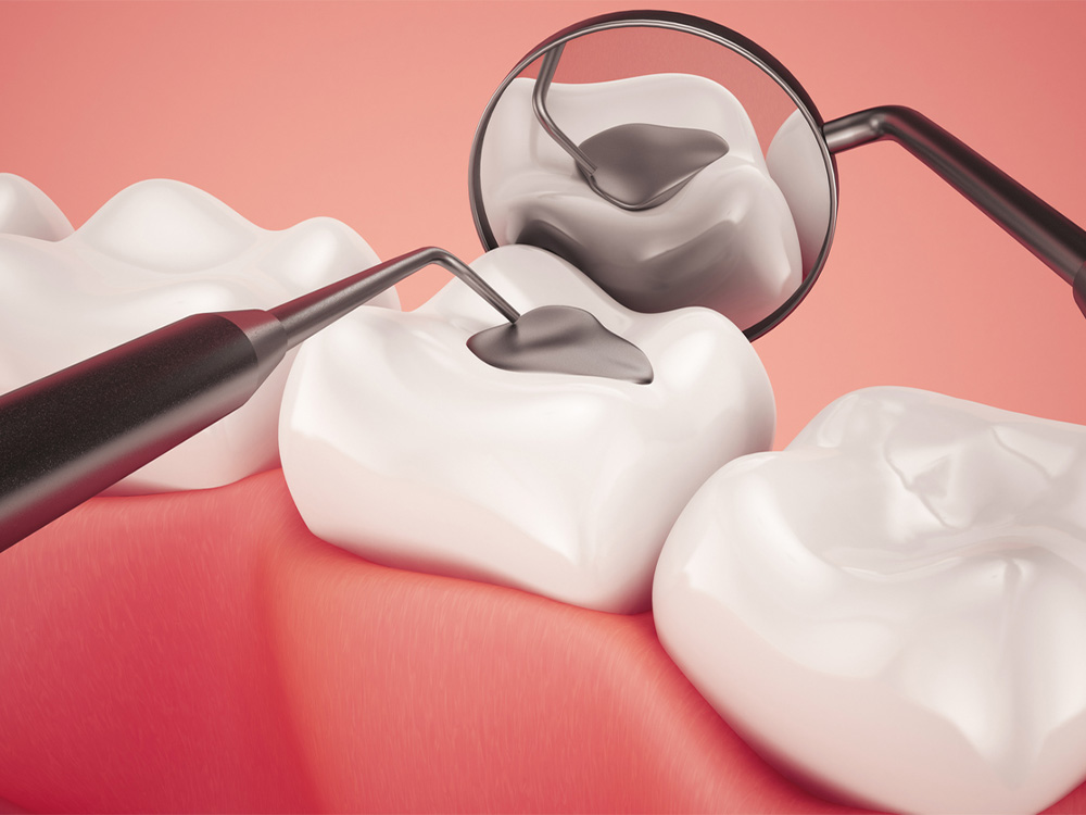 Tooth Fillings and Sealants - Matthews, NC - Urgent Dental
