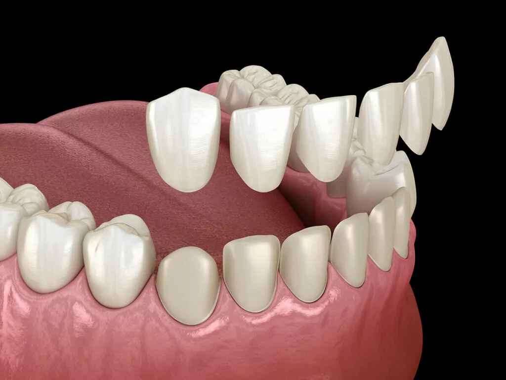 Mockup of dental veneers being fitted to front bottom teeth