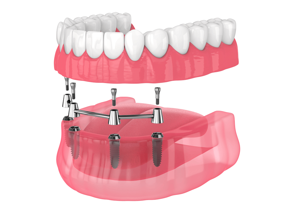 All-on-4 dental implants example model image